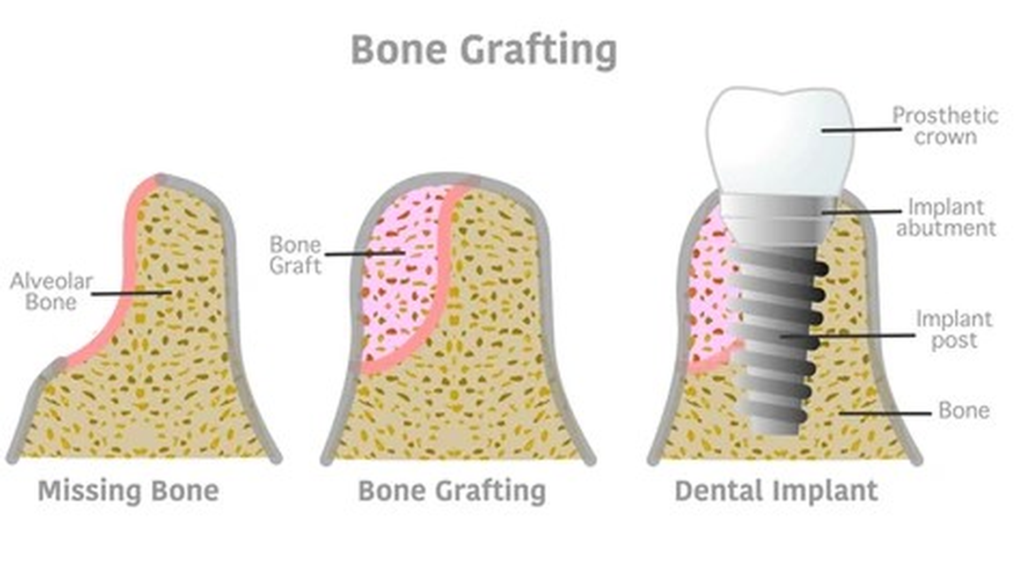 bone_grafting_highres