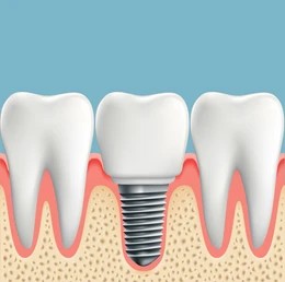human-teeth-dental-implant-stock-260nw-422594686 Illustrated depiction of a dental implant attached between natural teeth for aesthetics and function.